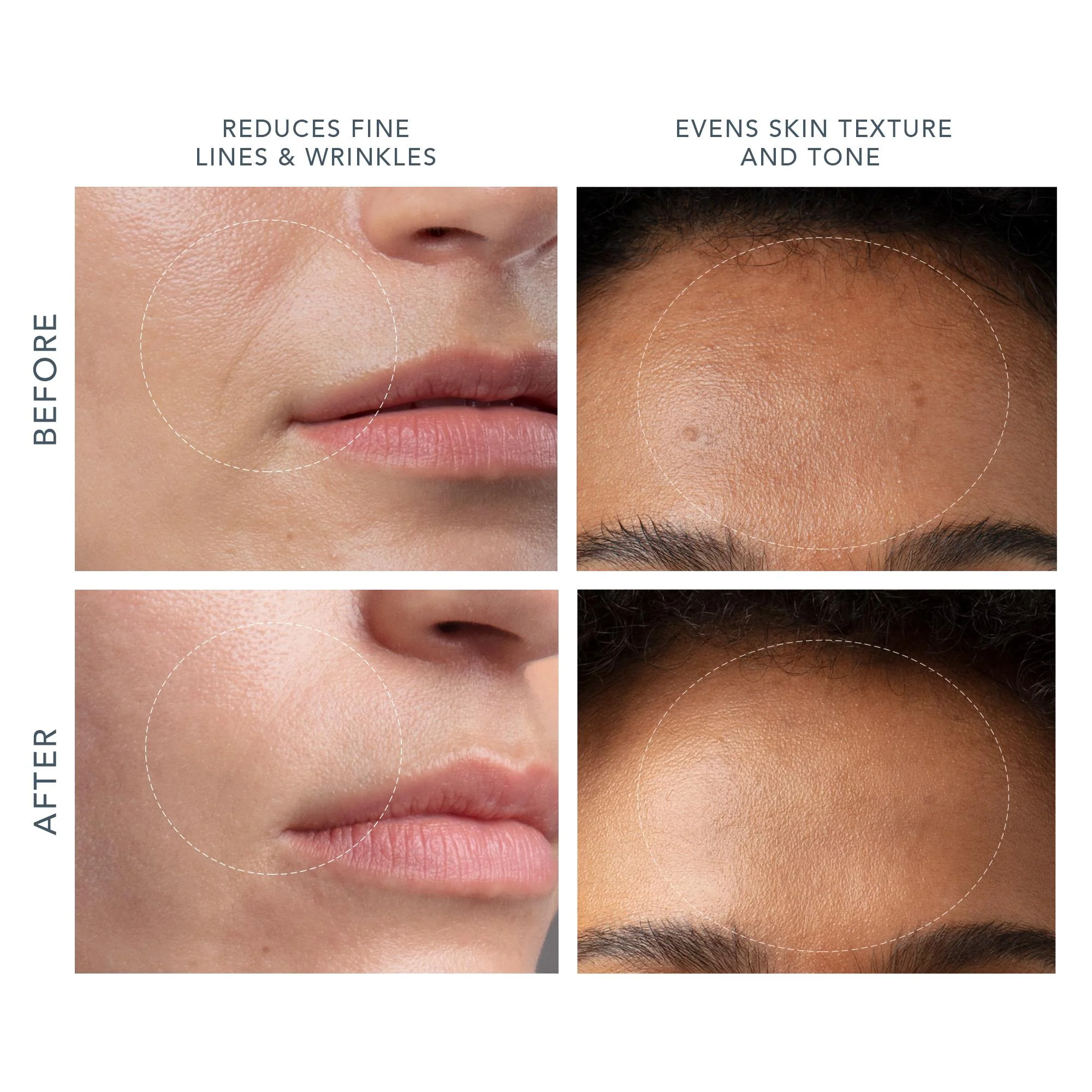 Foreo Kiwi Microdermabrasion (Lavendar) - Image 8